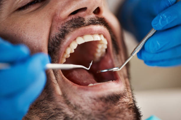 Best Emergency Treatment for Dental Infections or Abscesses in Palm Beach, FL